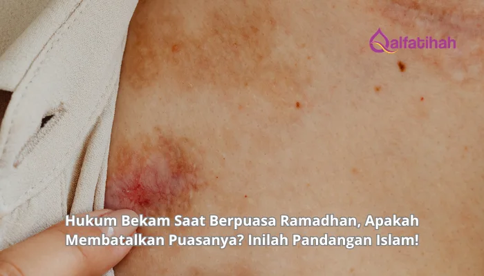 Hukum Bekam Saat Berpuasa Ramadhan, Apakah Membatalkan Puasanya? Inilah Pandangan Islam!